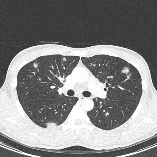 AIDS-related Kaposi sarcoma (Radiopaedia 85247-100811 Axial lung window 67).jpg