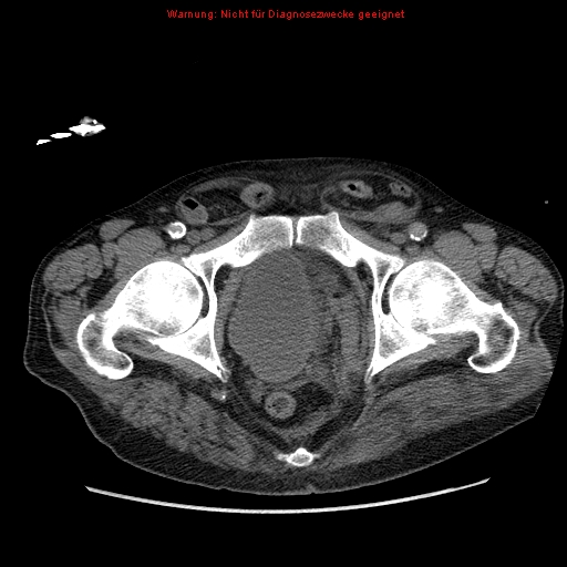 File:Abdominal aortic aneurysm- extremely large, ruptured (Radiopaedia 19882-19921 Axial C+ arterial phase 76).jpg