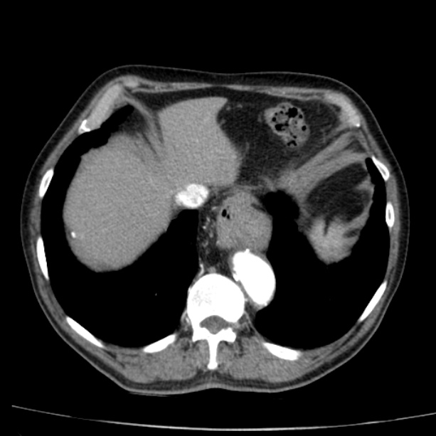 Abdominal aortic aneurysm (Radiopaedia 29248-29660 Axial C+ arterial phase 9).jpg