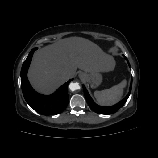 File:Abdominal aortic aneurysm (Radiopaedia 57318-64259 Axial C+ arterial phase 10).jpg