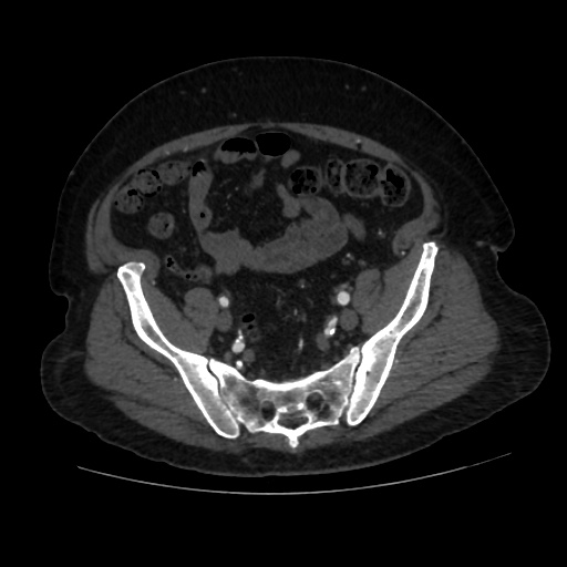 File:Abdominal aortic aneurysm (Radiopaedia 57318-64259 Axial C+ arterial phase 58).jpg