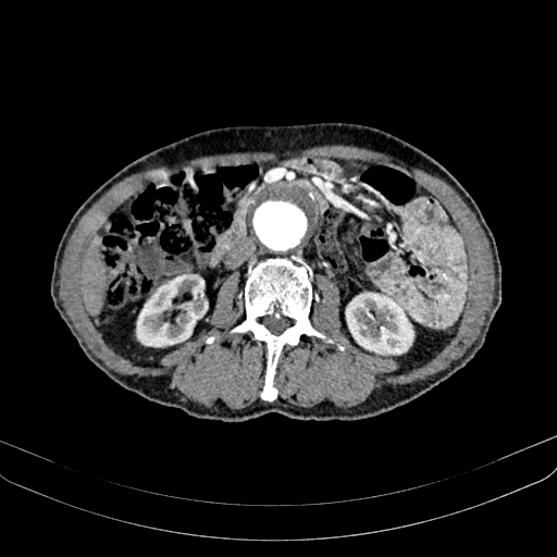 Abdominal aortic aneurysm (Radiopaedia 83581-98689 Axial C+ arterial phase 59).jpg