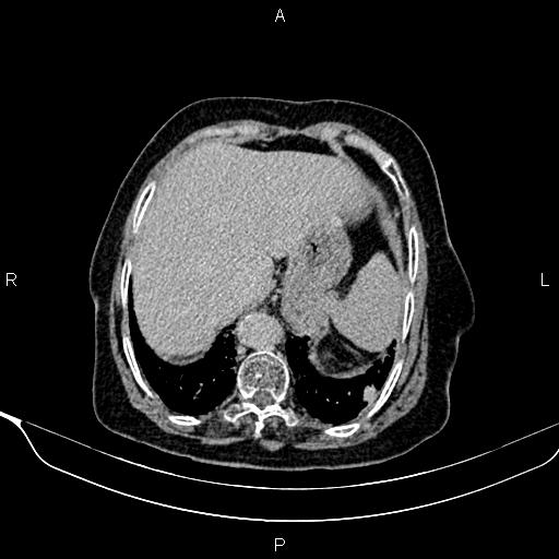 Abdominal aortic aneurysm (Radiopaedia 85063-100606 Axial C+ delayed 1).jpg