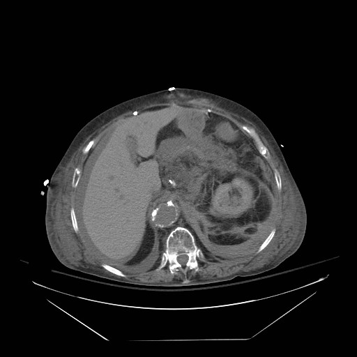 File:Abdominal aortic aneurysm - impending rupture (Radiopaedia 19233-19247 Axial non-contrast 51).jpg