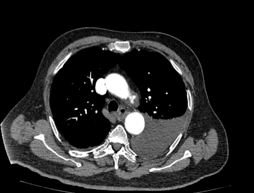 Abdominal aortic aneurysm rupture (Radiopaedia 54179-60362 Axial C+ arterial phase 6).jpg