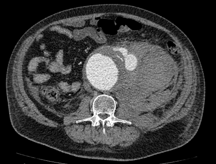 Abdominal aortic aneurysm rupture (Radiopaedia 54179-60362 Axial C+ portal venous phase 18).jpg
