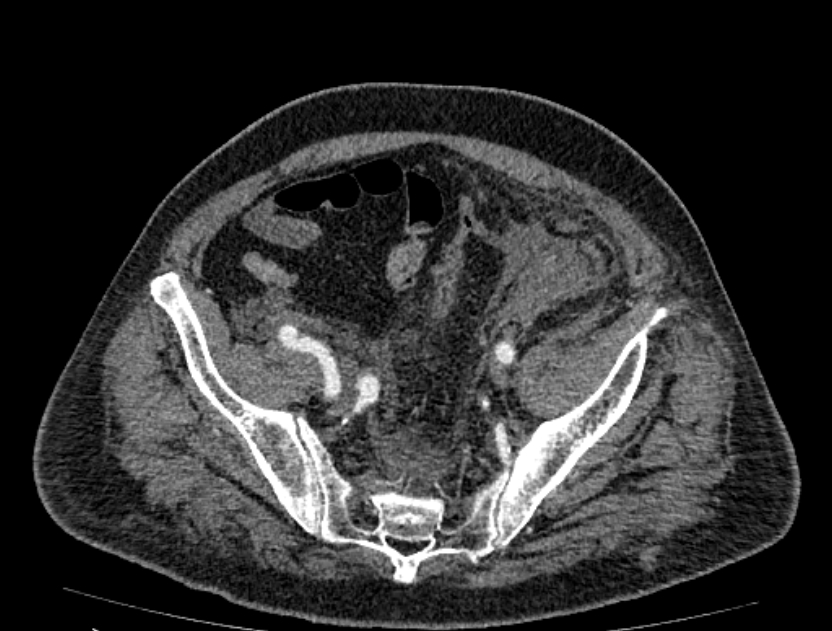 Abdominal aortic aneurysm rupture (Radiopaedia 54179-60362 Axial C+ portal venous phase 6).jpg