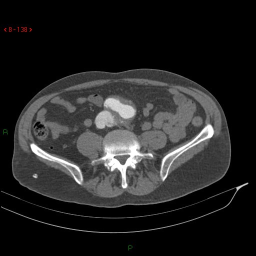 Abdominal aortic aneurysm rupture with aortocaval fistula (Radiopaedia 14897-14841 Axial C+ arterial phase 138).jpg