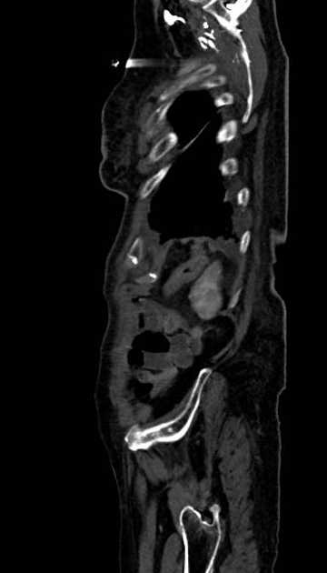 Abdominal aortic aneurysm with thrombus fissuration (Radiopaedia 73192-83919 Sagittal C+ arterial phase 9).jpg