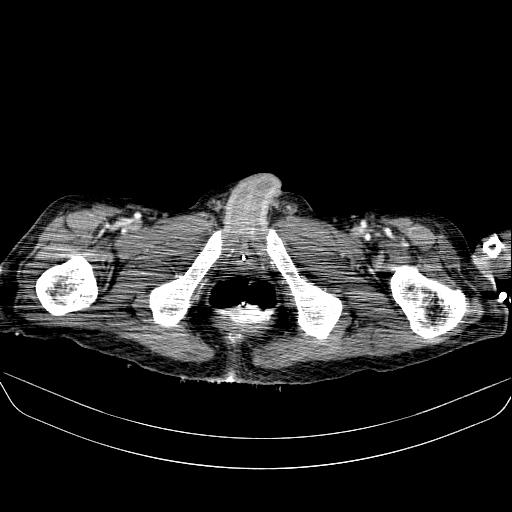 File:Abdominal collection due to previous cecal perforation (Radiopaedia 80831-94320 Axial C+ portal venous phase 221).jpg