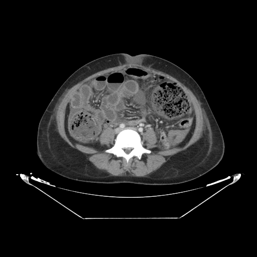 Abdominal gossypiboma- surgical towel (Radiopaedia 57288-64226 Axial C+ portal venous phase 46).jpg