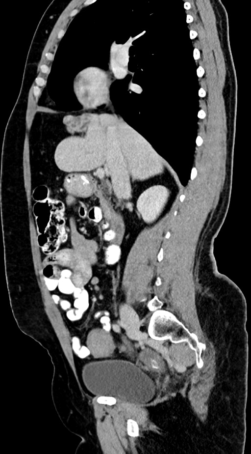 Abdominal hydatid disease (Radiopaedia 68223-77737 Sagittal C+ portal venous phase 43).jpg