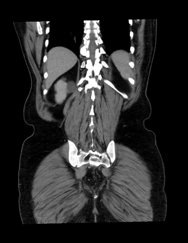 Abdominal lymphoma - with sandwich sign (Radiopaedia 53486-59492 C+ portal venous phase 9).jpg