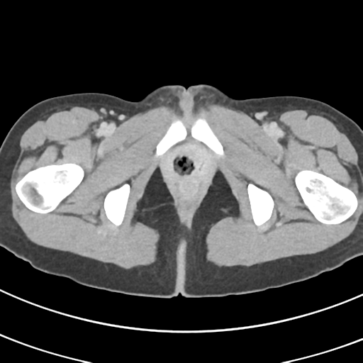 File:Abdominal multi-trauma - devascularised kidney and liver, spleen and pancreatic lacerations (Radiopaedia 34984-36486 Axial C+ delayed 84).png