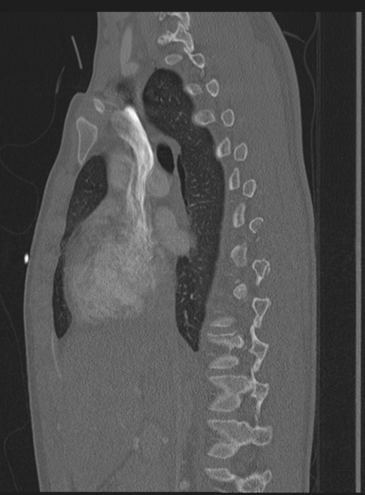 Abdominal multi-trauma - devascularised kidney and liver, spleen and pancreatic lacerations (Radiopaedia 34984-36486 Sagittal bone window 45).png