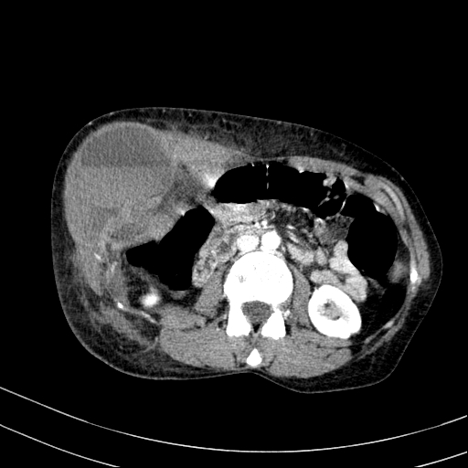Abdominal wall hematoma with active bleeding (Radiopaedia 83915-99117 Axial renal cortical phase 38).jpg