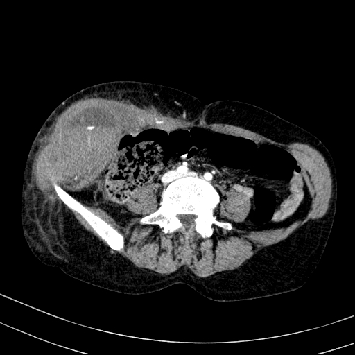 Abdominal wall hematoma with active bleeding (Radiopaedia 83915-99117 Axial renal cortical phase 72).jpg