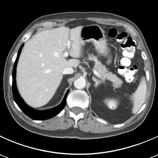 File:Abdominal wall metastasis from colorectal carcinoma (Radiopaedia 31016-31717 Axial C+ portal venous phase 19).jpg