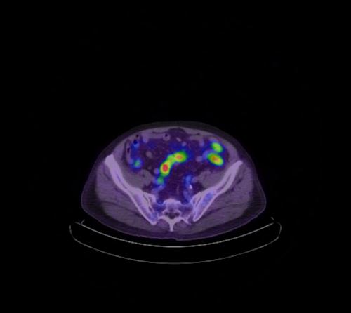 Abdominal wall metastasis from colorectal carcinoma (Radiopaedia 31016-31719 Axial 39).jpg