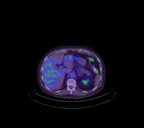 Abdominal wall metastasis from colorectal carcinoma (Radiopaedia 31016-31719 Axial 84).jpg