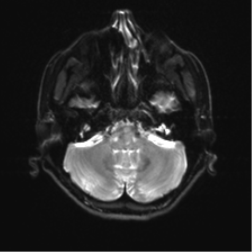 Abducens nerve palsy (Radiopaedia 51069-56648 Axial DWI 5).png