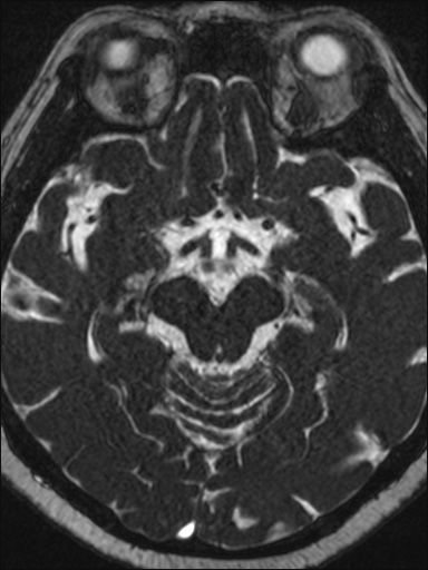 Abducens nerve palsy (Radiopaedia 57084-63976 Axial T2 ciss 3d 57).jpg