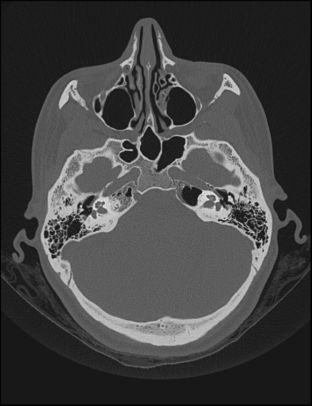 Aberrant right internal carotid artery (Radiopaedia 65191-74198 Axial non-contrast 44).jpg