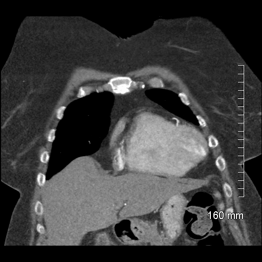 Aberrant right subclavian artery stenosis (Radiopaedia 52656-58670 B 25).jpg