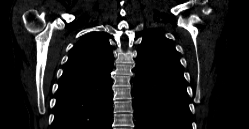 Accesory rib joint (Radiopaedia 71987-82452 Coronal bone window 40).jpg