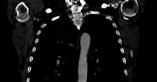 Accesory rib joint (Radiopaedia 71987-82452 Coronal bone window 8).jpg