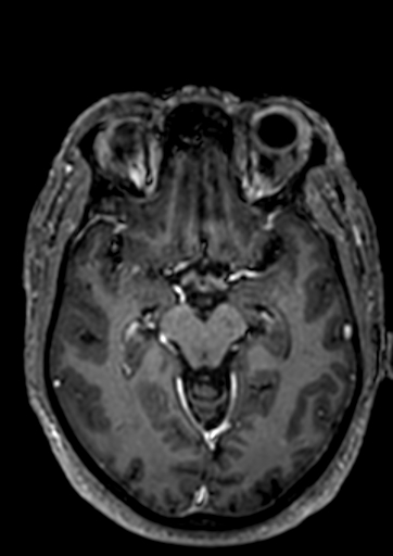 File:Accessory middle cerebral artery (Radiopaedia 73114-83828 Axial T1 C+ 66).jpg