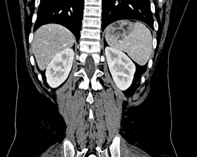 Accessory right inferior hepatic vein (Radiopaedia 75207-86305 Coronal C+ portal venous phase 62).jpg