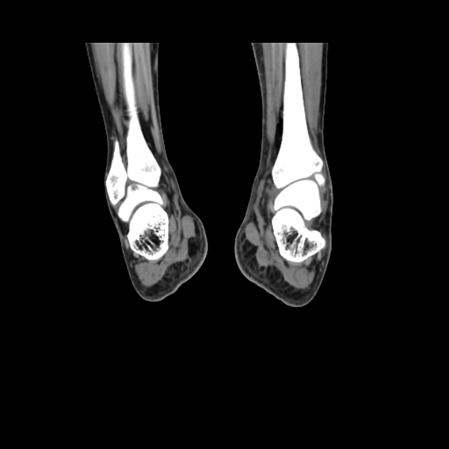 Accessory soleus muscle (Radiopaedia 61069-68943 Coronal non-contrast 50).jpg