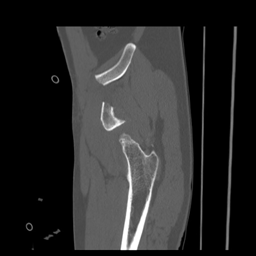 Acetabular and ilial fractures (Radiopaedia 59084-66378 Sagittal bone window 15).jpg