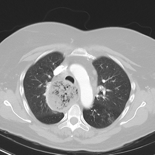 File:Achalasia (Radiopaedia 47147-51685 Axial lung window 17).png