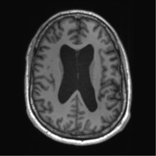 File:Achondroplasia (Radiopaedia 65109-74105 Axial T1 21).png