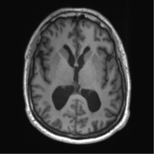 File:Achondroplasia (Radiopaedia 65109-74105 Axial T1 27).png