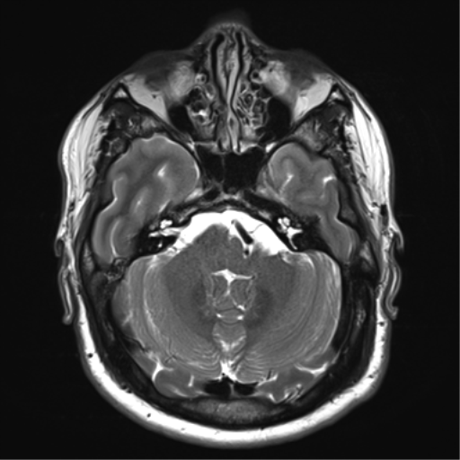 File:Achondroplasia (Radiopaedia 65109-74105 Axial T2 8).png