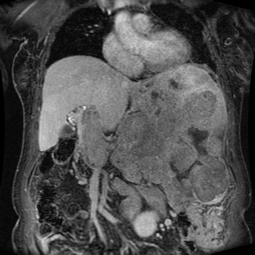 Acinar cell carcinoma of the pancreas (Radiopaedia 75442-86668 Coronal T1 C+ fat sat 117).jpg