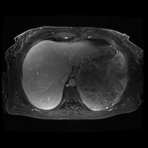 Acinar cell carcinoma of the pancreas (Radiopaedia 75442-86668 D 116).jpg