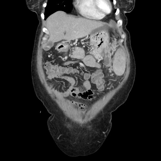 Acinar cell carcinoma of the pancreas (Radiopaedia 75442-86669 Coronal C+ portal venous phase 29).jpg