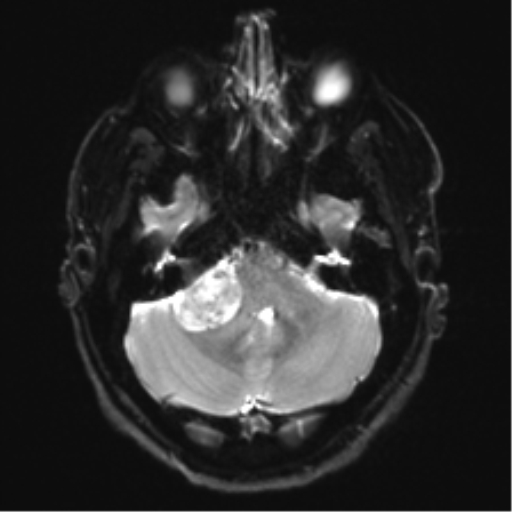 Acoustic schwannoma (Radiopaedia 50846-56358 Axial DWI 7).png