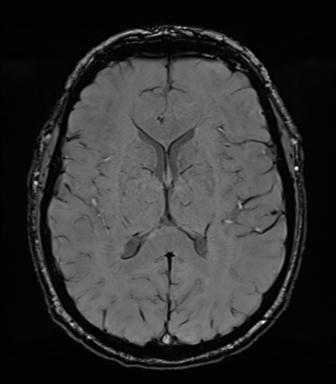 Acoustic schwannoma (Radiopaedia 50846-56358 Axial SWI 53).png