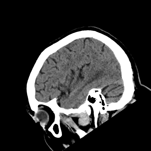 File:Acoustic schwannoma (Radiopaedia 55729-62280 Sagittal non-contrast 8).png