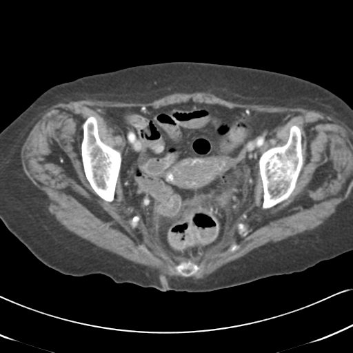 Active bleeding from duodenal ulcer with embolization (Radiopaedia 34216-35481 C 58).png