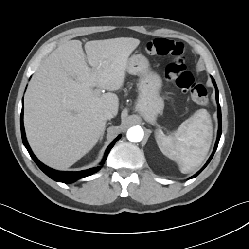 File:Active diverticular hemorrhage (Radiopaedia 39415-41725 Axial C+ arterial phase 13).png