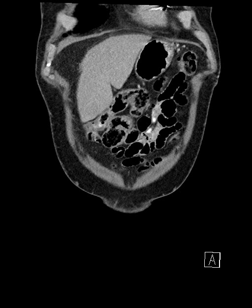 Active lower gastrointestinal bleeding - diverticular (Radiopaedia 61203-69106 Coronal C+ portal venous phase 20).jpg