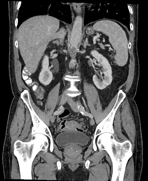 Active lower gastrointestinal bleeding - diverticular (Radiopaedia 61203-69106 Coronal C+ portal venous phase 79).jpg