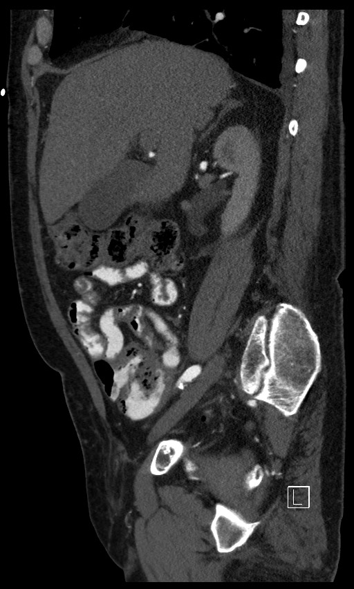 Active lower gastrointestinal bleeding - diverticular (Radiopaedia 61203-69106 Sagittal C+ arterial phase 106).jpg