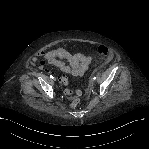 File:Active renal extravasation with large subcapsular and retroperitoneal hemorrhage (Radiopaedia 60975-68796 Axial 102).jpg